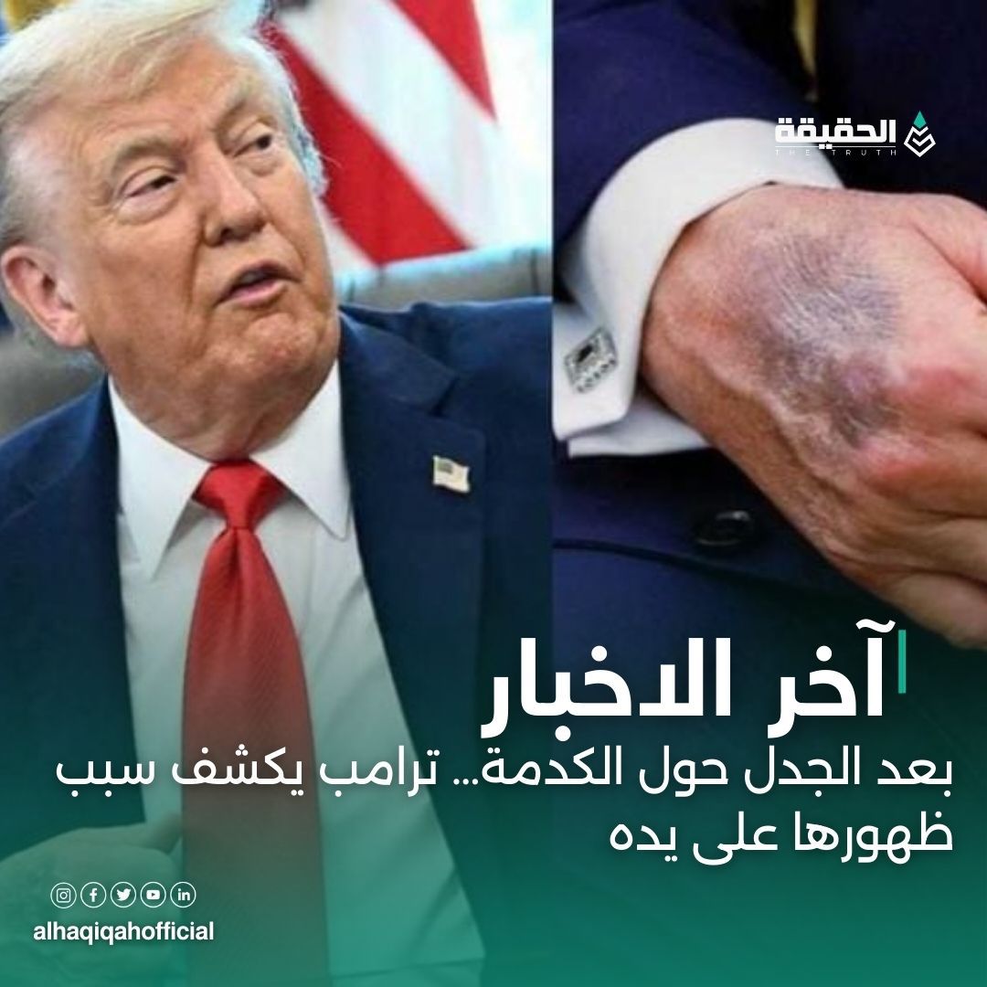 بعد الجدل حول الكدمة… ترامب يكشف سبب ظهورها على يده
